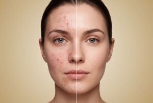 Điều trị mụn chuẩn y khoa