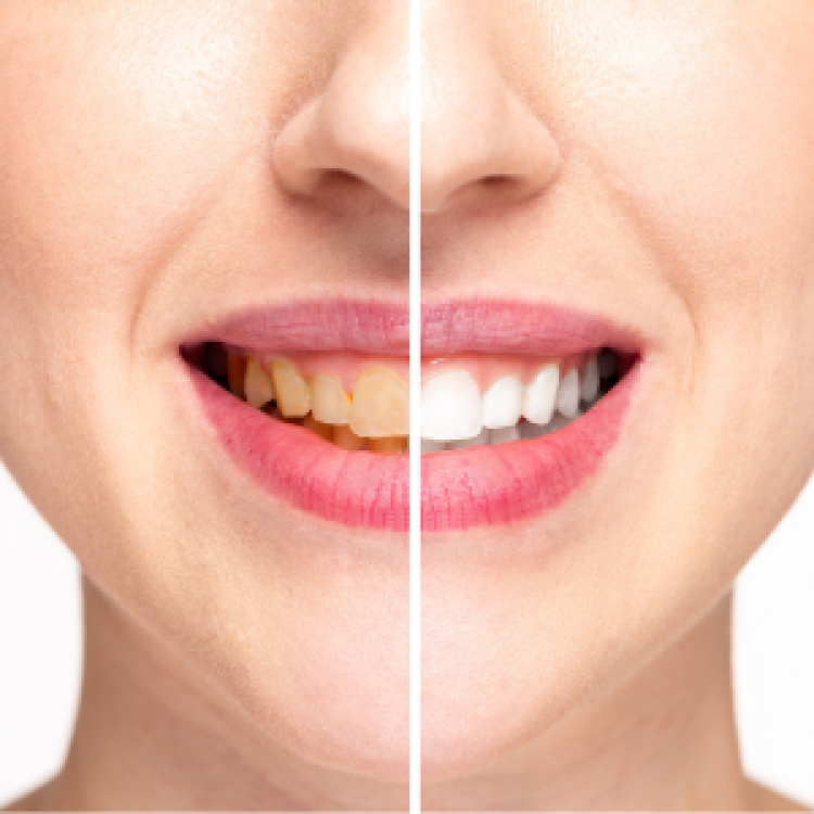 Before and After Teeth Whitening