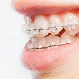 Ceramic Braces