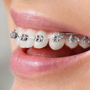 Dental Braces