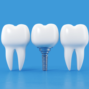 Dental Implants