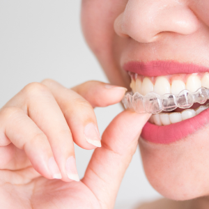 Invisalign Braces