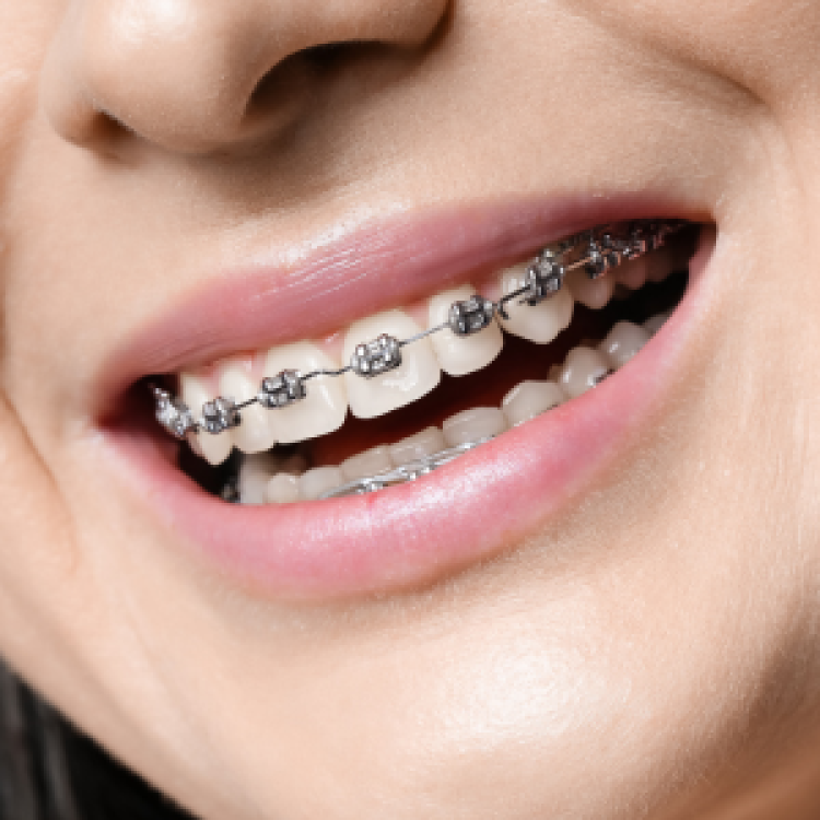 Metal braces