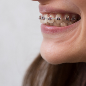 Metallic Braces