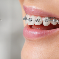 Dental Braces