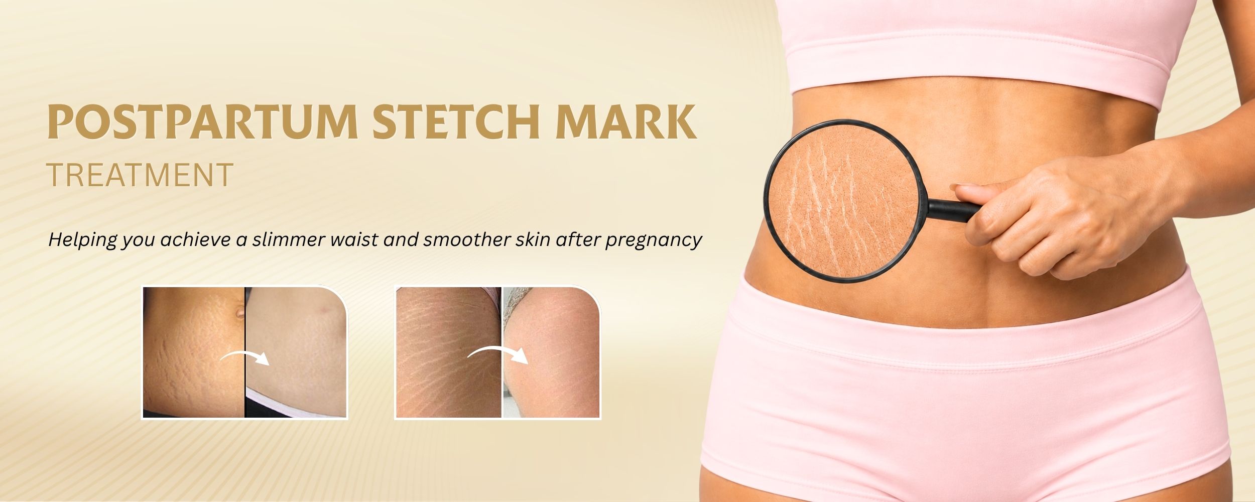 Gói điều trị rạn da cao cấp dáng đẹp, eo thon cho mẹ bỉm sau sinh