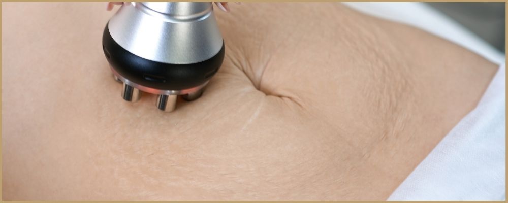 Điều trị rạn da sau sinh bằng công nghệ RF Microneeding