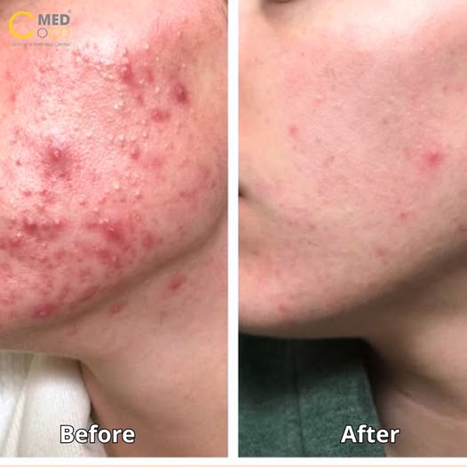 điều trị mụn hiệu quả bằng laser