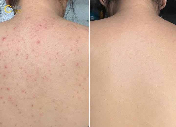 Điều trị mụn lưng hiệu quả
