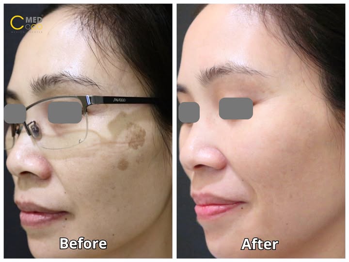 Trị nám bằng phác đồ điều trị riêng tại CocoMed