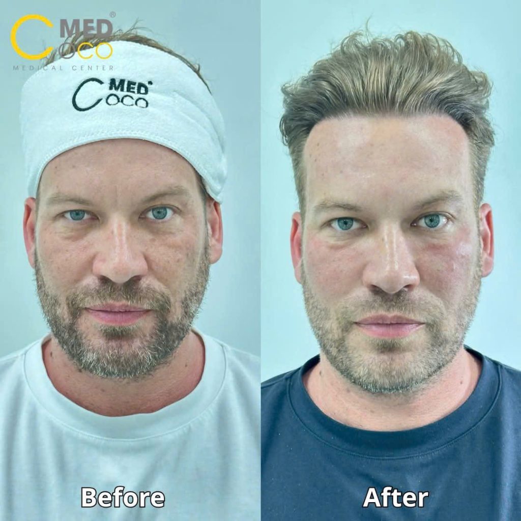 Công nghệ thẩm mỹ Laser CO2 Fractional