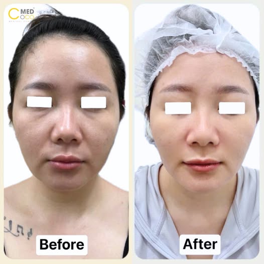 Liệu trình RF Microneeding