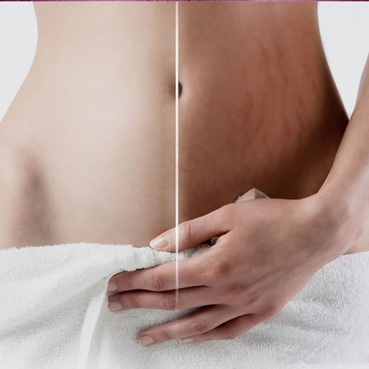 Điều trị rạn da sau sinh