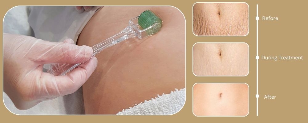Điều trị rạn da sau sinh với các gói điều trị cao cấp