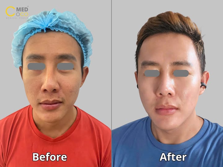 hành trình tái tạo làn da với công nghệ Microneedling + Fractional CO2