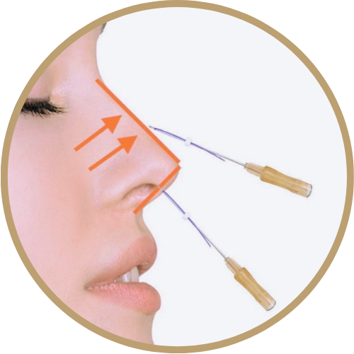 Nâng mũi bằng phương pháp căng chỉ tạo nên dáng mũi hài hoà, tự nhiên