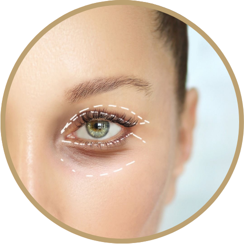 Căng chỉ vùng mắt giúp nâng đuôi mắt xệ và kích thích tăng sinh collagen