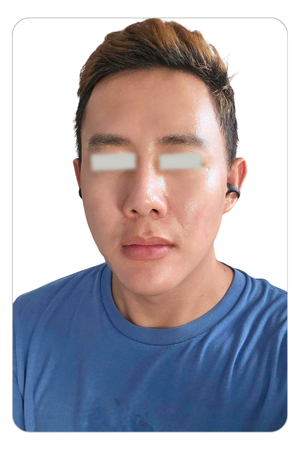 Liệu trình trẻ hoá da tại CocoMed Quận 2, TP. HCM