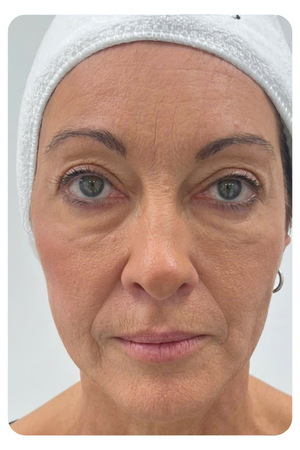 Liệu trình trẻ hoá da bằng RF micro needling và fractional co2