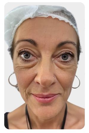 Liệu trình trẻ hoá da bằng RF micro needling và fractional co2