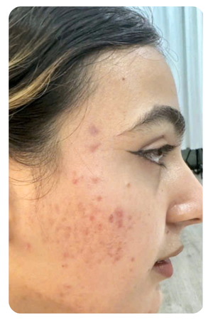 điều trị sẹo mụn quận 2