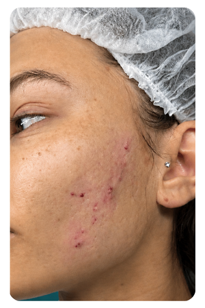 Điều trị sẹo mụn quận 2
