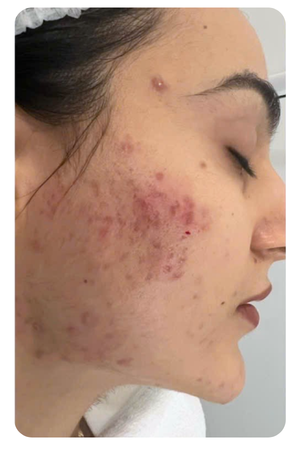 điều trị sẹo mụn quận 2