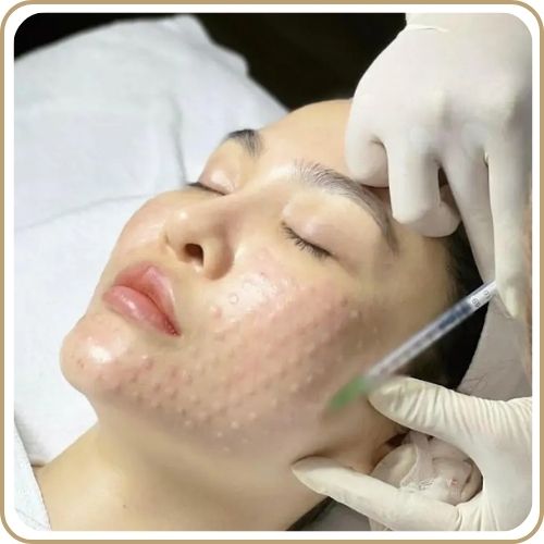 Điều trị sẹo bằng phương pháp Meso