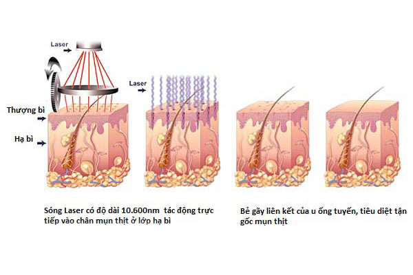 Cơ chế hoạt động của Laser fractional CO2