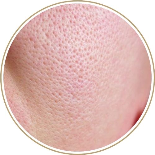 Điều trị sẹo đáy nhọn