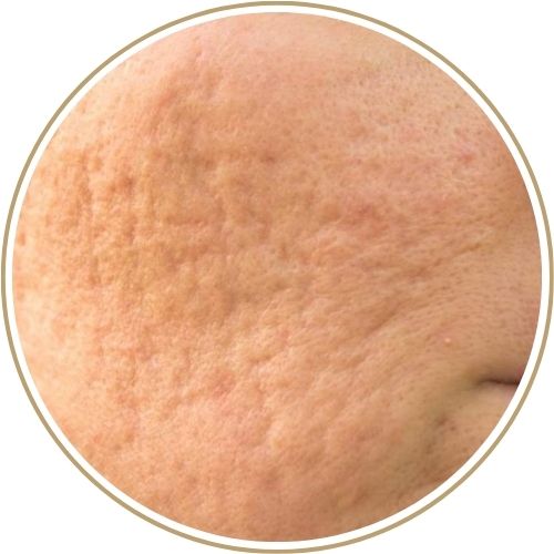 Điều trị sẹo đáy tròn