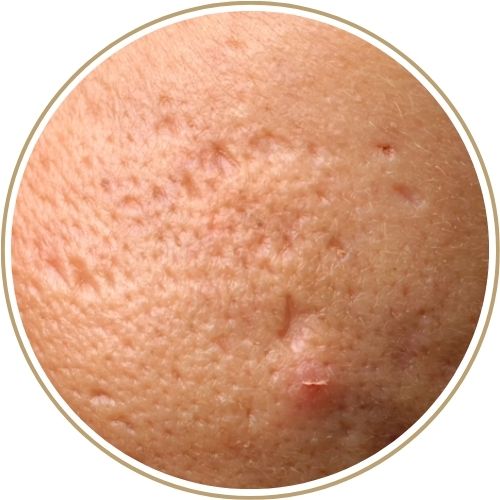 Điều trị sẹo đáy vuông